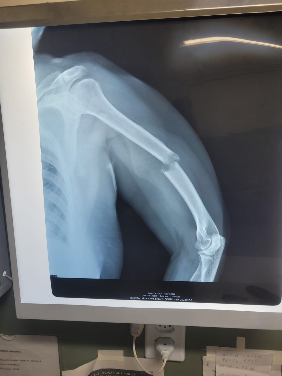 Família diz que mulher teve braço quebrado durante cirurgia na coluna em hospital público do Rio  