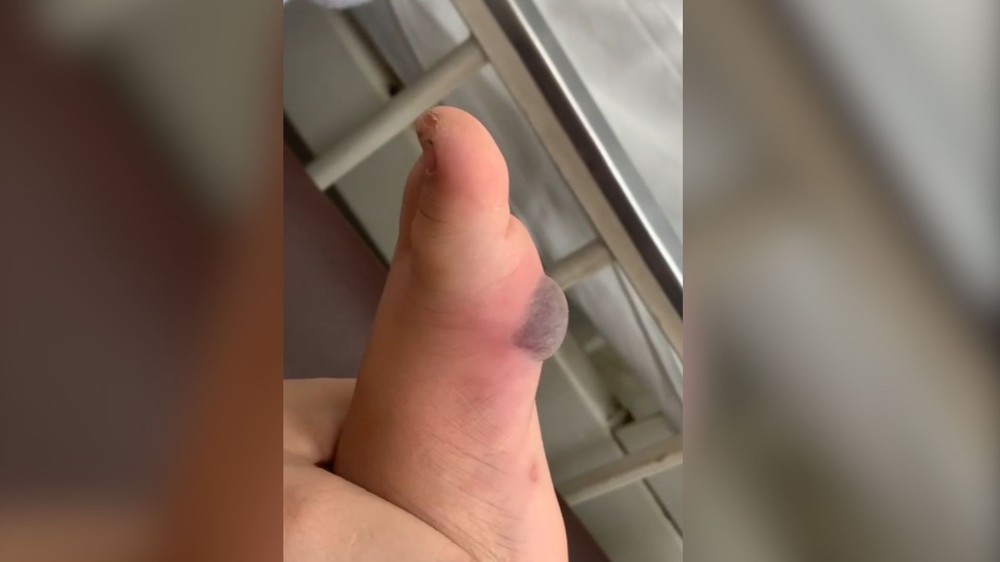 Após ser picada por aranha, criança tem parte da pele do pé retirada em hospital de Rio Preto-SP