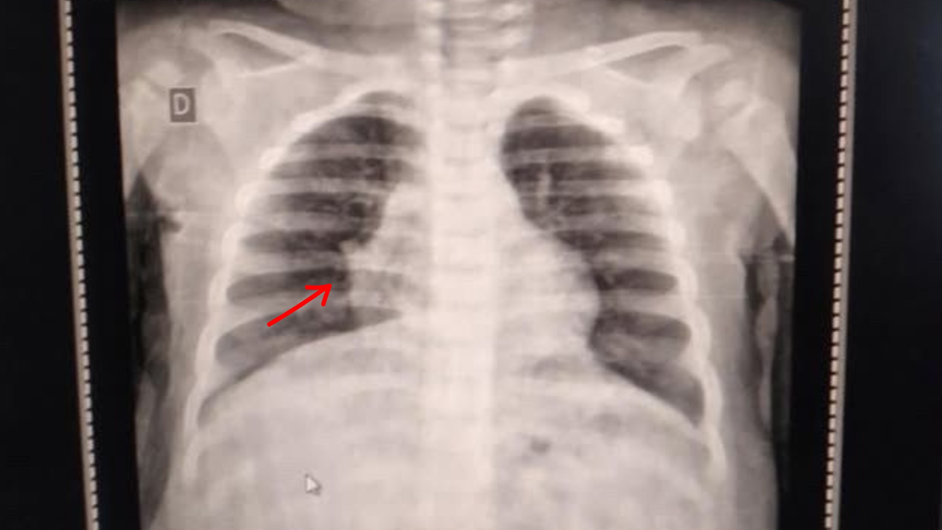 Bebê com pneumonia e dependente de oxigênio nasal espera vaga em hospital há 4 dias: 'Não aguento mais ver ela sofrer', lamenta mãe