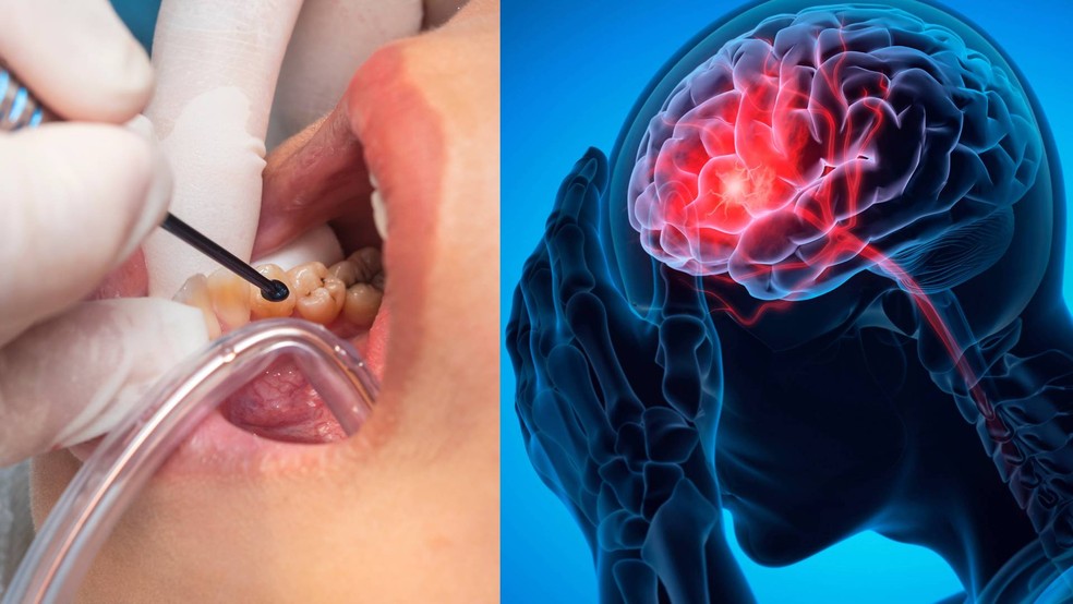 O que cárie e gengivite têm a ver com AVC? Estudo indica aumento  significativo no risco de derrame | G1