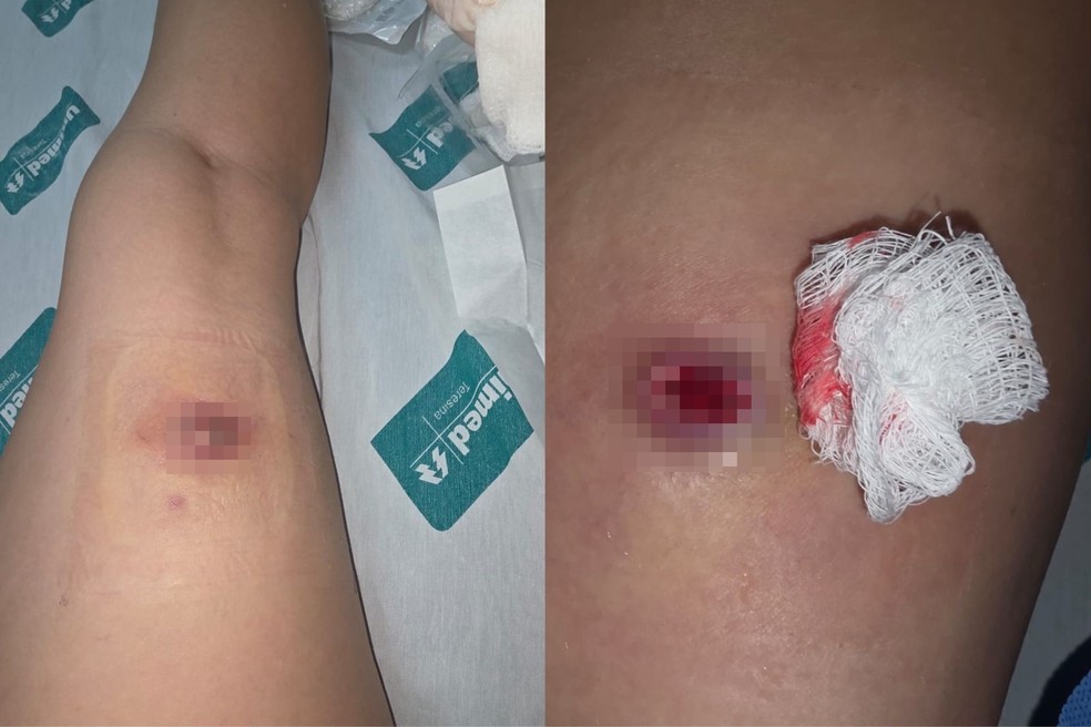 Dentista precisou ser internada após sofrer picada de aranha-marrom — Foto: Arquivo pessoal