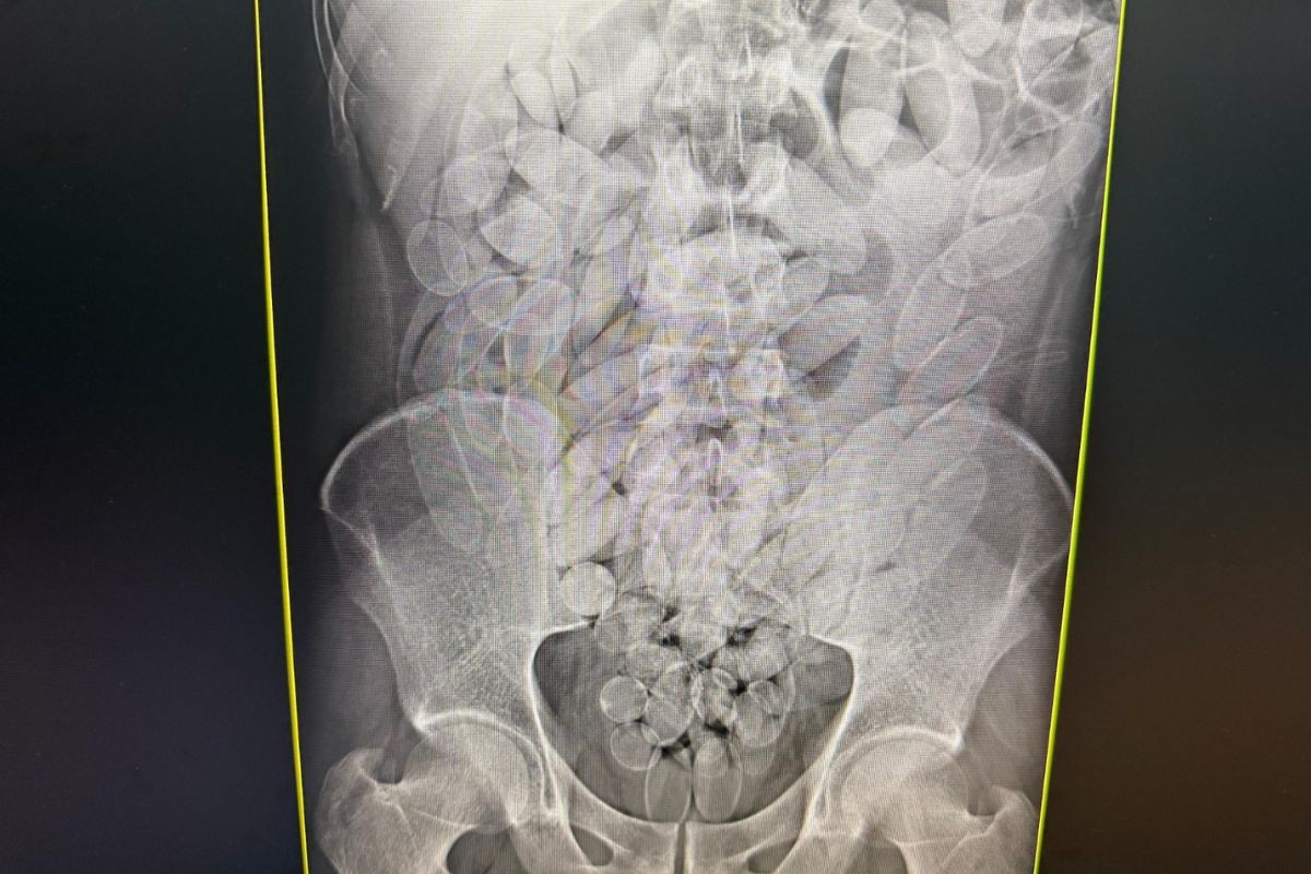 Oito bolivianos são presos com 645 cápsulas de cocaína no estômago em Corumbá; veja vídeo