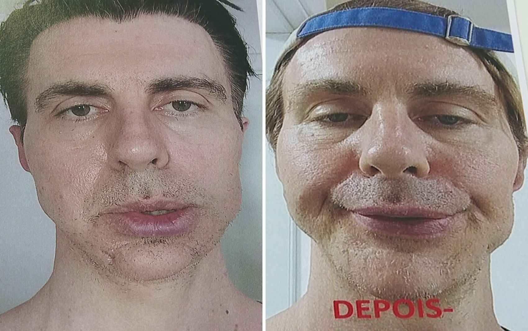 Paciente diz que passou por cirurgia de emergência após procedimento estético de dentista: 'Saí literalmente deformado' 