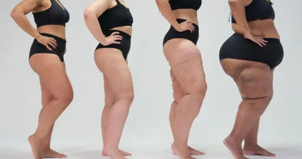 Lipedema atinge 12% das mulheres e é frequentemente confundido com obesidade ou celulite