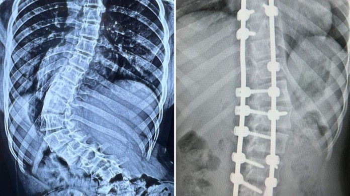 Cirurgia que mudou vida de menina que tinha 'coluna em S' completa