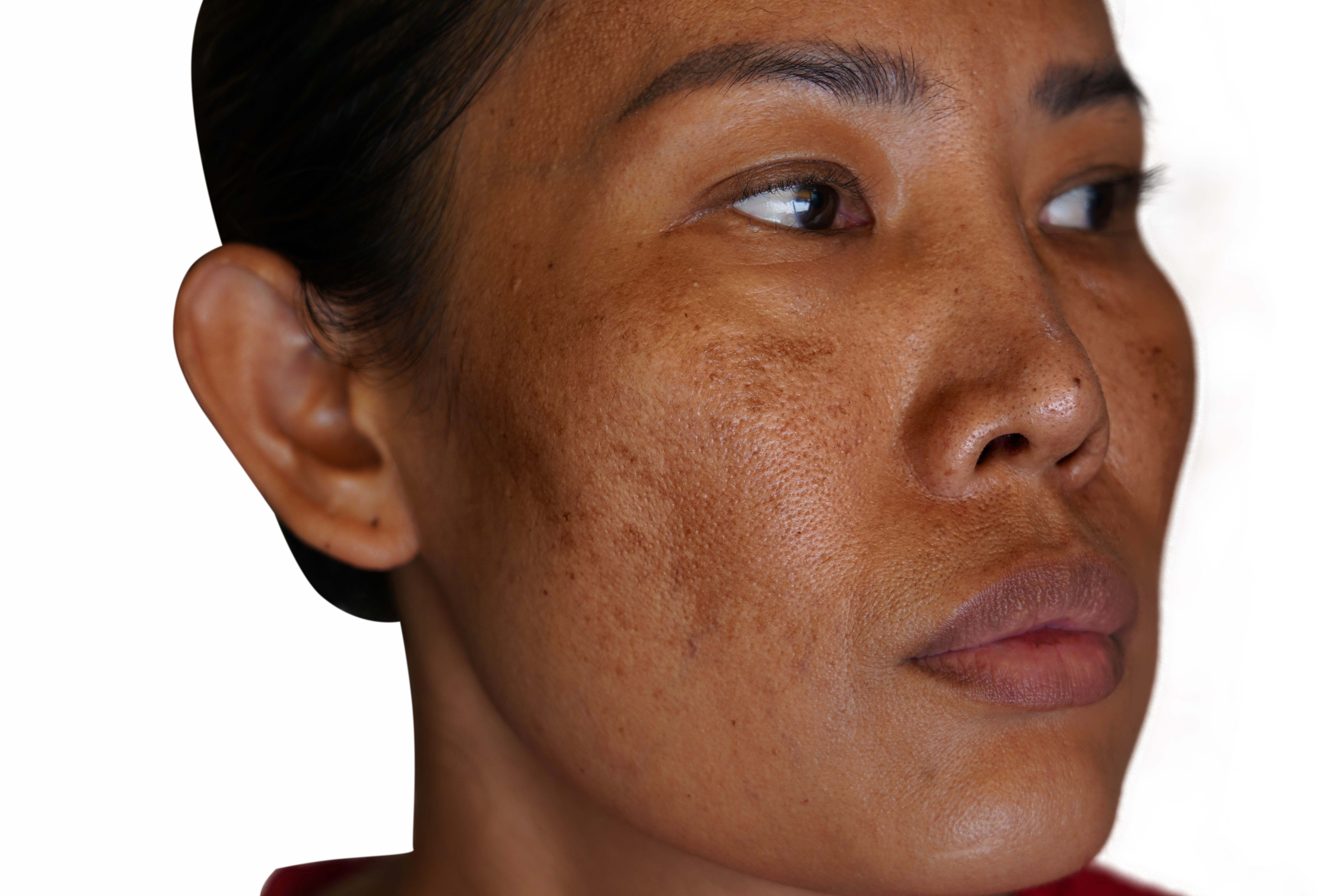 Manchas em formato de borboleta na face? A ciência mostra como a dieta ajuda a prevenir e tratar o melasma