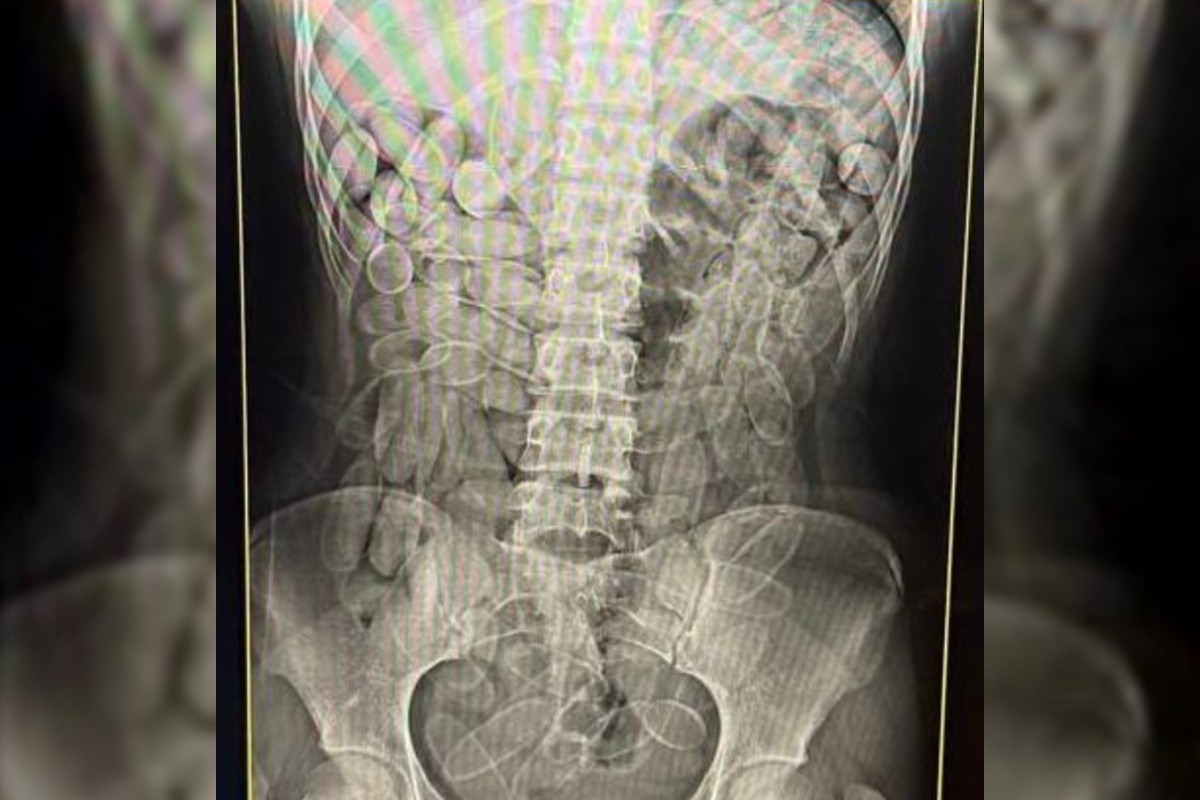 Jovem vomita cápsula de cocaína em policial e entrega 'mulas' com 2,2 kg da droga no estômago