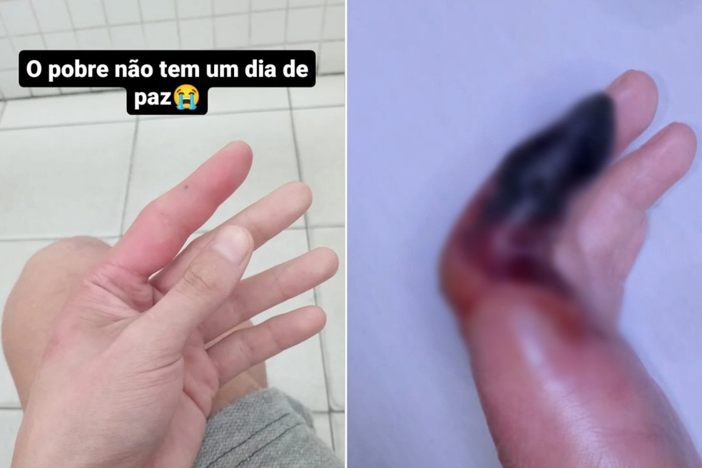 Garçom ficou com o dedo necrosado e precisou amputá-lo após ter sido picado por aranha-marrom em Praia Grande (SP) — Foto: Arquivo Pessoal