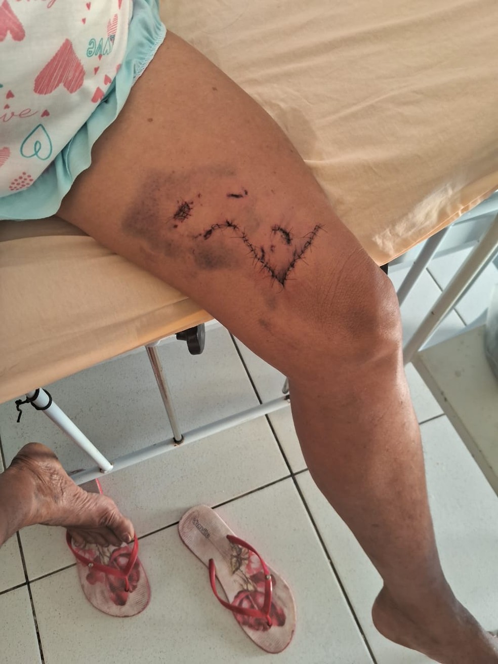 Agricultora é ataca por onça em Carnaubeira da Penha, no Sertão. — Foto: Arquivo pessoal
