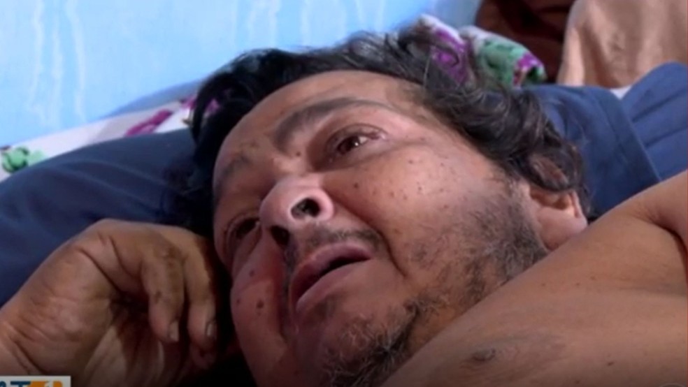 Al&eacute;m da trombose, Renato j&aacute; apresenta ferimentos causados pelo longo per&iacute;odo em que permanece no local, sem sair da cama. &mdash; Foto: TV Centro Am&eacute;rica