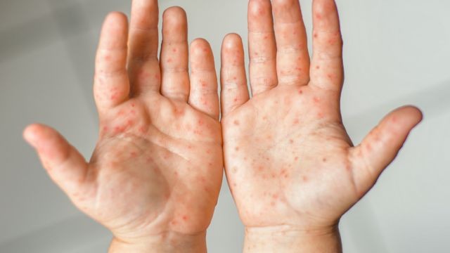Surtos de síndrome mão-pé-boca são registrados em escolas infantis de Porto Alegre: mais de 160 pessoas foram contaminadas