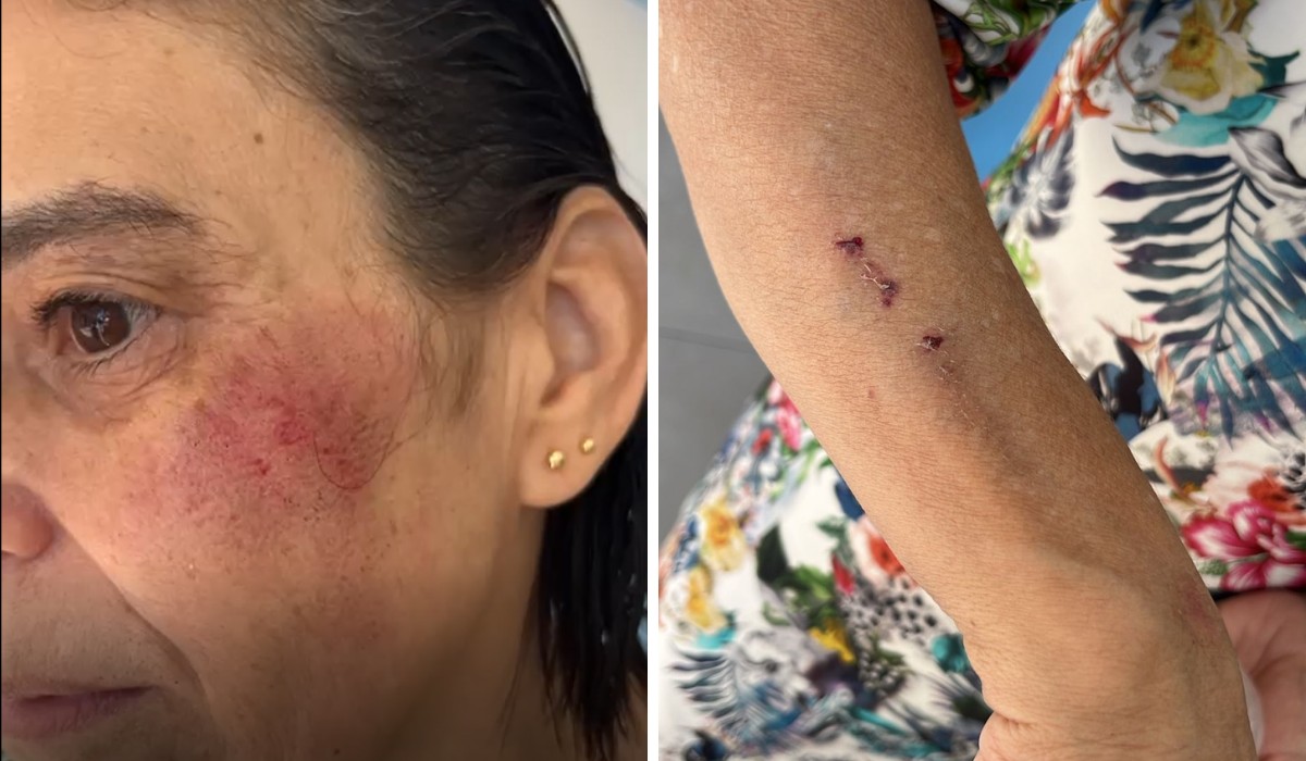 Passageira cai e se machuca ao sair de ônibus com princípio de incêndio em Campinas