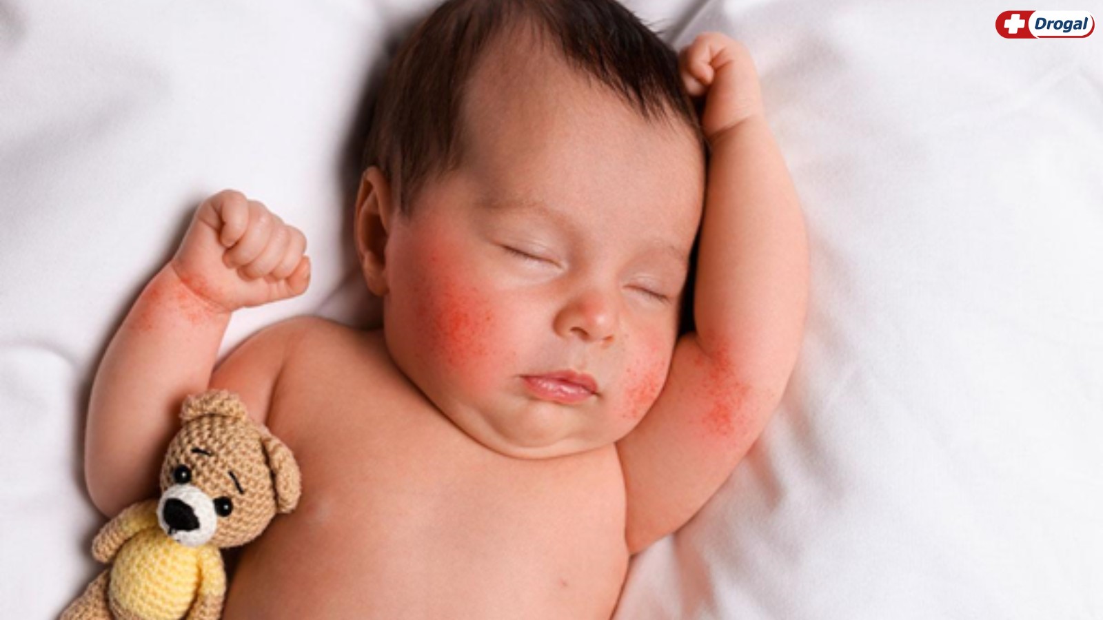 Pomada para alergia na pele de bebê: como agir quando surgem assaduras e irritações