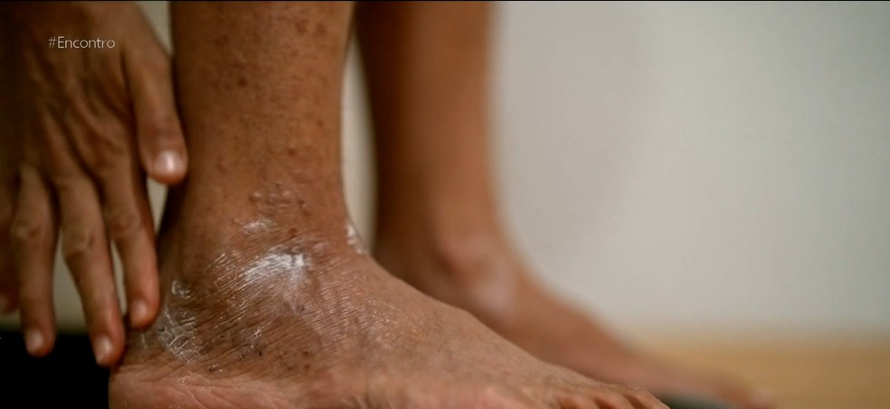 Dermatite atópica afeta especialmente as dobras do corpo — Foto: reprodução Bem Estar