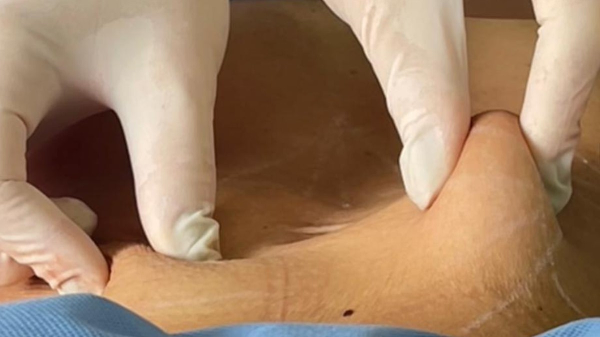 
Técnica inovadora de lipo sem cirurgia é lançada por grupo catarinense