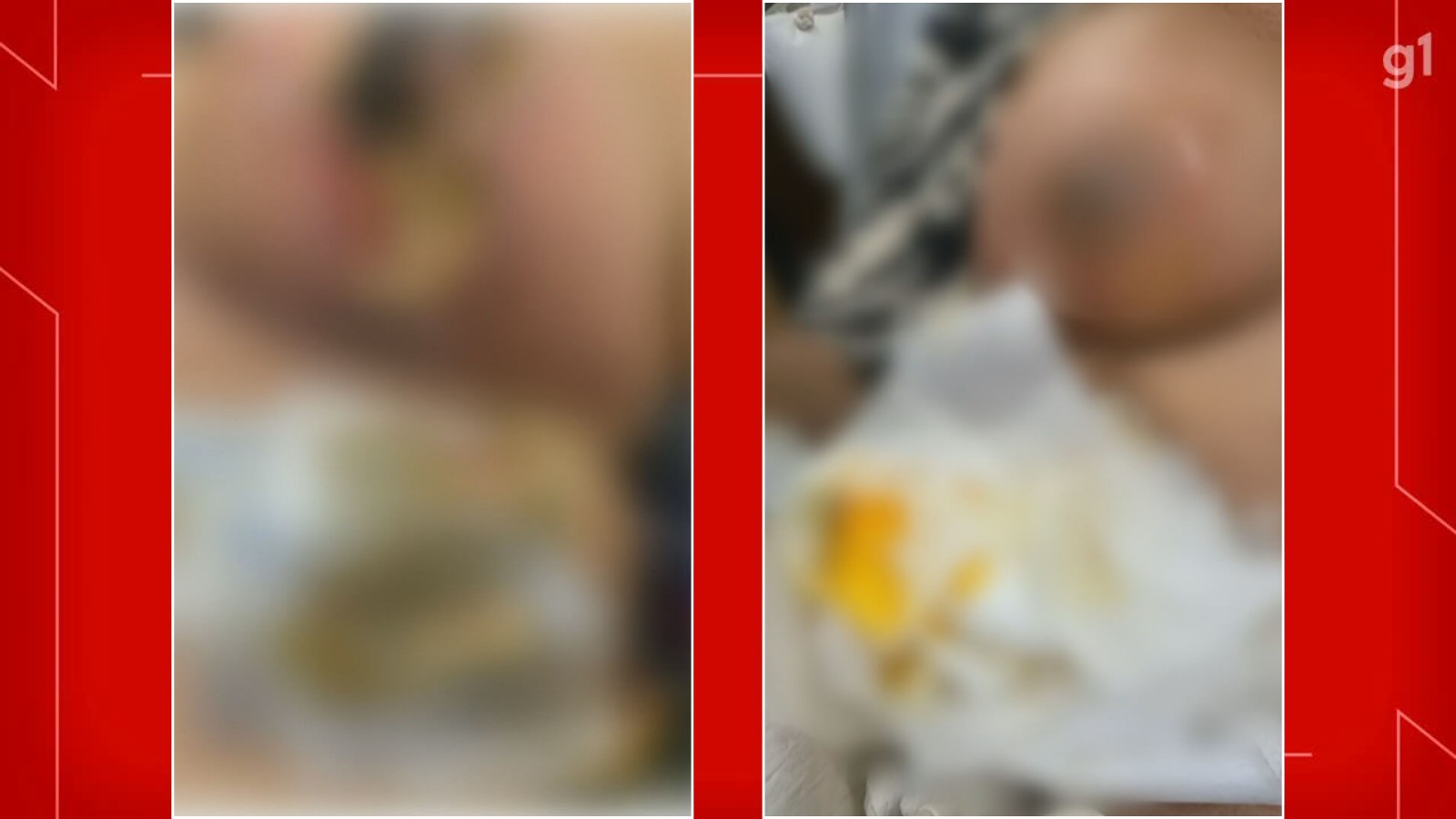 Médico é indiciado por lesão gravíssima após paciente perder mama no DF; cirurgião já havia sido alvo de denúncias em 2019