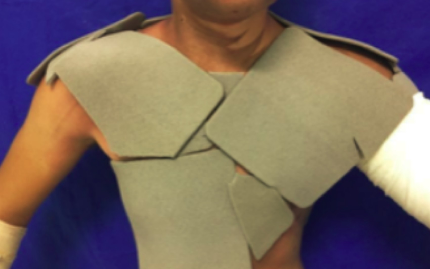 Como pesquisadores concluíram que curativo mais caro pode deixar tratamento contra queimaduras mais barato e eficiente