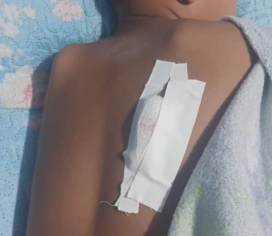 Criança de 6 anos é perfurada por vergalhão transportado em moto e dois homens são presos em Soure, no Marajó