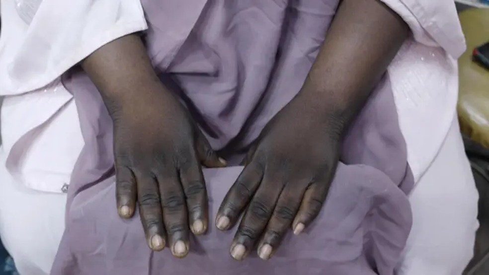 Os contrastes de cores nas mãos branqueadas às vezes são considerados semelhantes às marcas encontradas nas mãos de viciados em drogas — Foto: BBC
