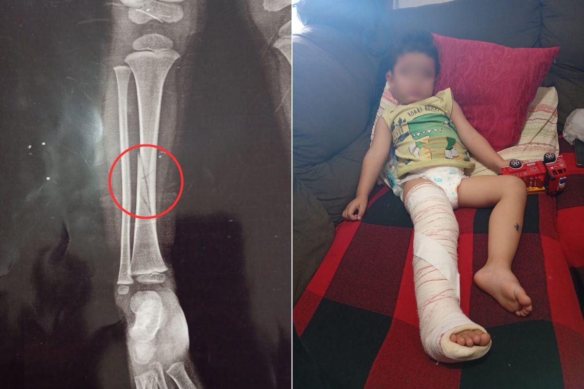 Menino de 2 anos fratura a perna após brigar com colega em creche no litoral de SP; mãe relata falta de socorro