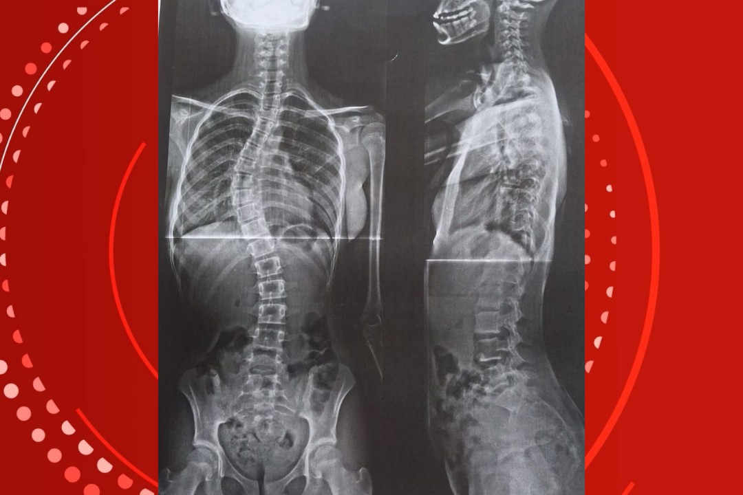 Mãe enfrenta a Justiça para salvar filha com coluna em formato de 'S' em RO