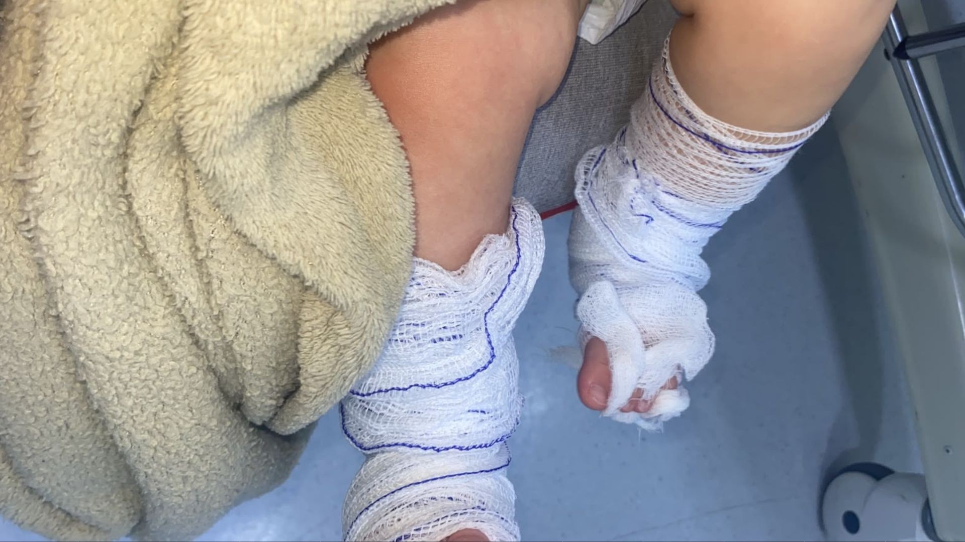 Prefeitura demite servidora envolvida em caso de bebê de 11 meses que teve queimaduras de 2º grau após banho em escola no RS