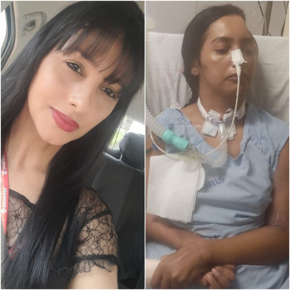 Gislaine antes e depois de perder parte do crânio — Foto: Arquivo pessoal