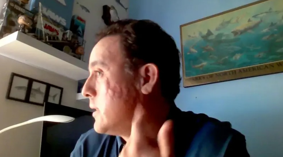 Hoyos mostra com orgulho a cicatriz deixada pelo tubarão: 'marca de batalha com forma de brânquias' — Foto: Arquivo Pessoal de Mauricio Hoyos