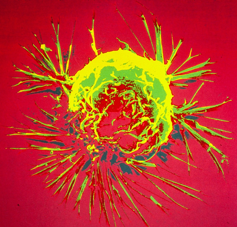 Pesquisadores utilizam biologia sintética para aprimorar bactérias no combate a tumores cancerígenos