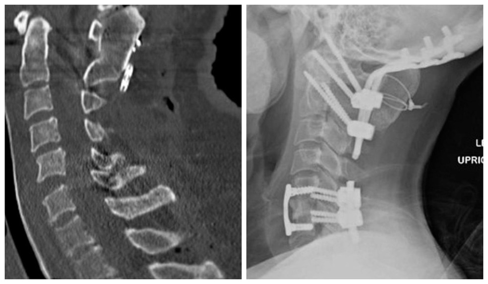 Dissociao craniocervical relatada pelo International Journal of Spine Surgery. — Foto: International Journal of Spine Surgery/Divulgao