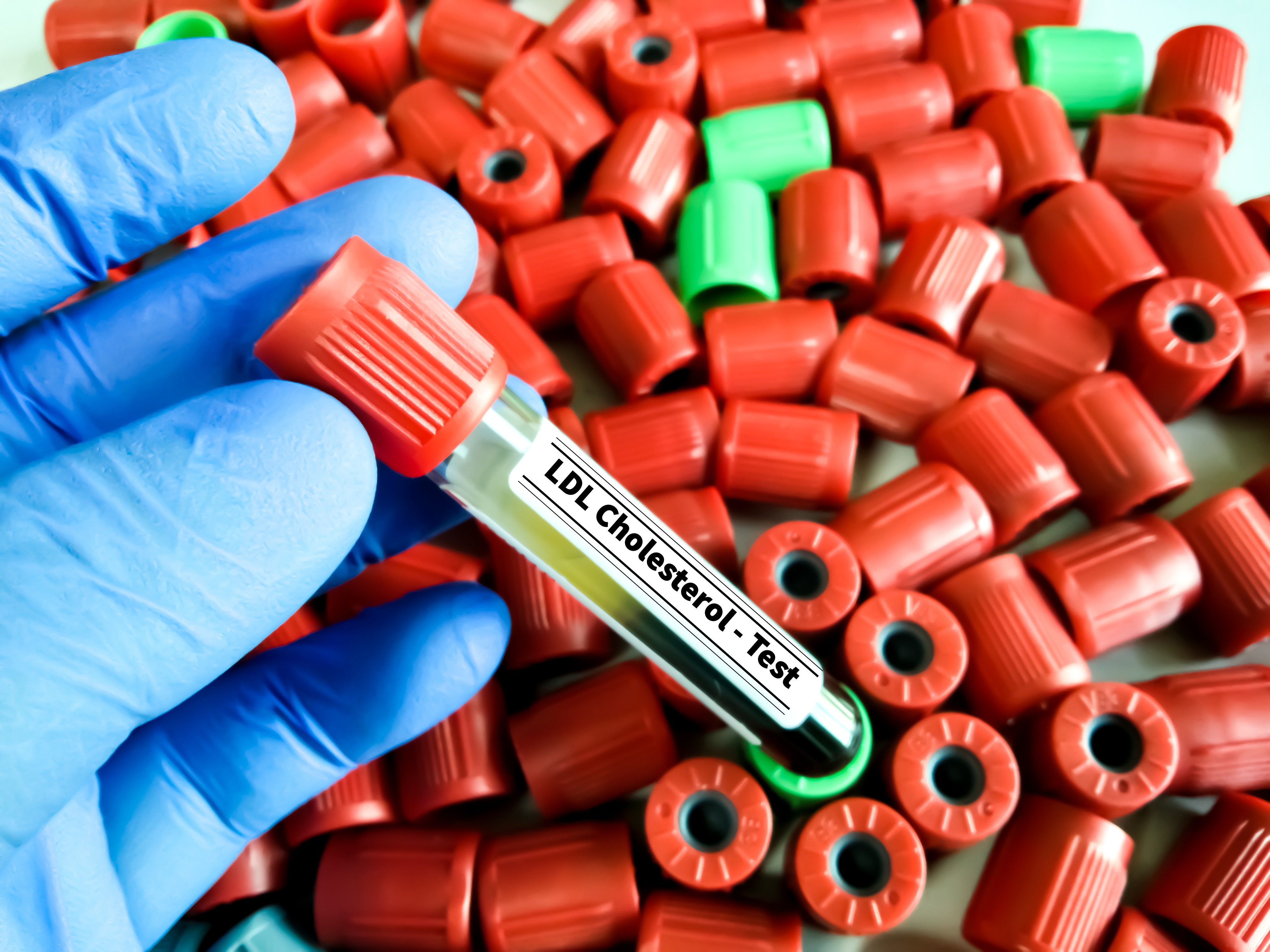 Pesquisa consegue controlar colesterol alto por até um ano com dose única de tratamento