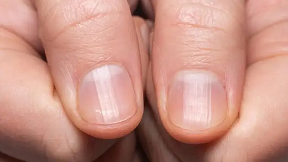 Pontinhos brancos estão ligados à dermatite atópica — Foto: Getty Images via BBC