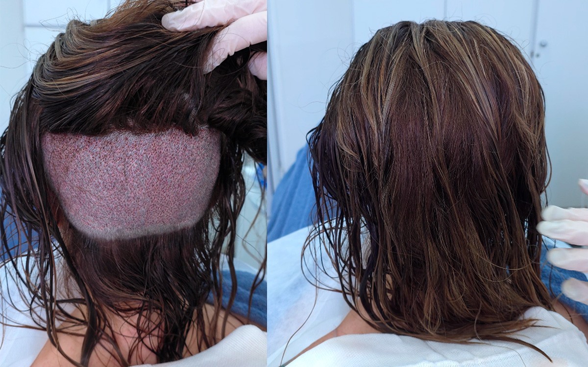 Transplante capilar em mulheres: quando o procedimento é indicado?