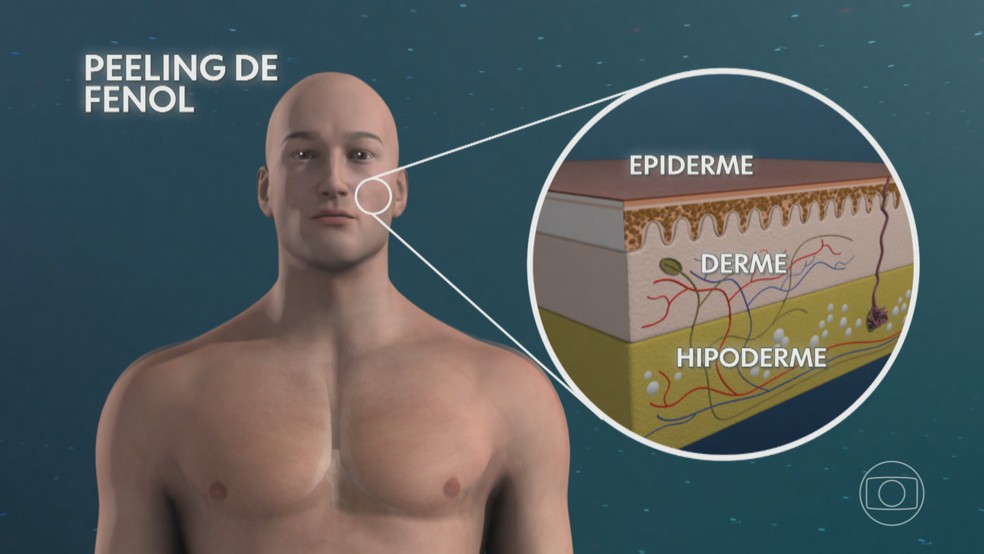 O peeling de fenol é considerado invasivo e o mais agressivo processo de descamação química da pele — Foto: Jornal Nacional/ Reprodução