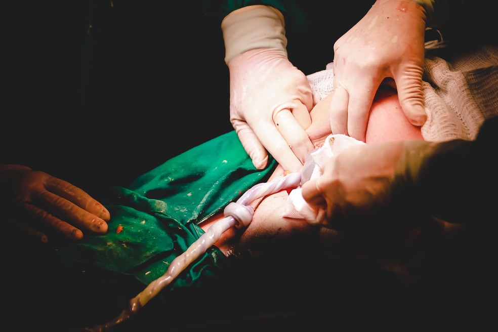 Nó em cordão umbilical de bebê Miguel — Foto: Débora Cunha/Divulgação