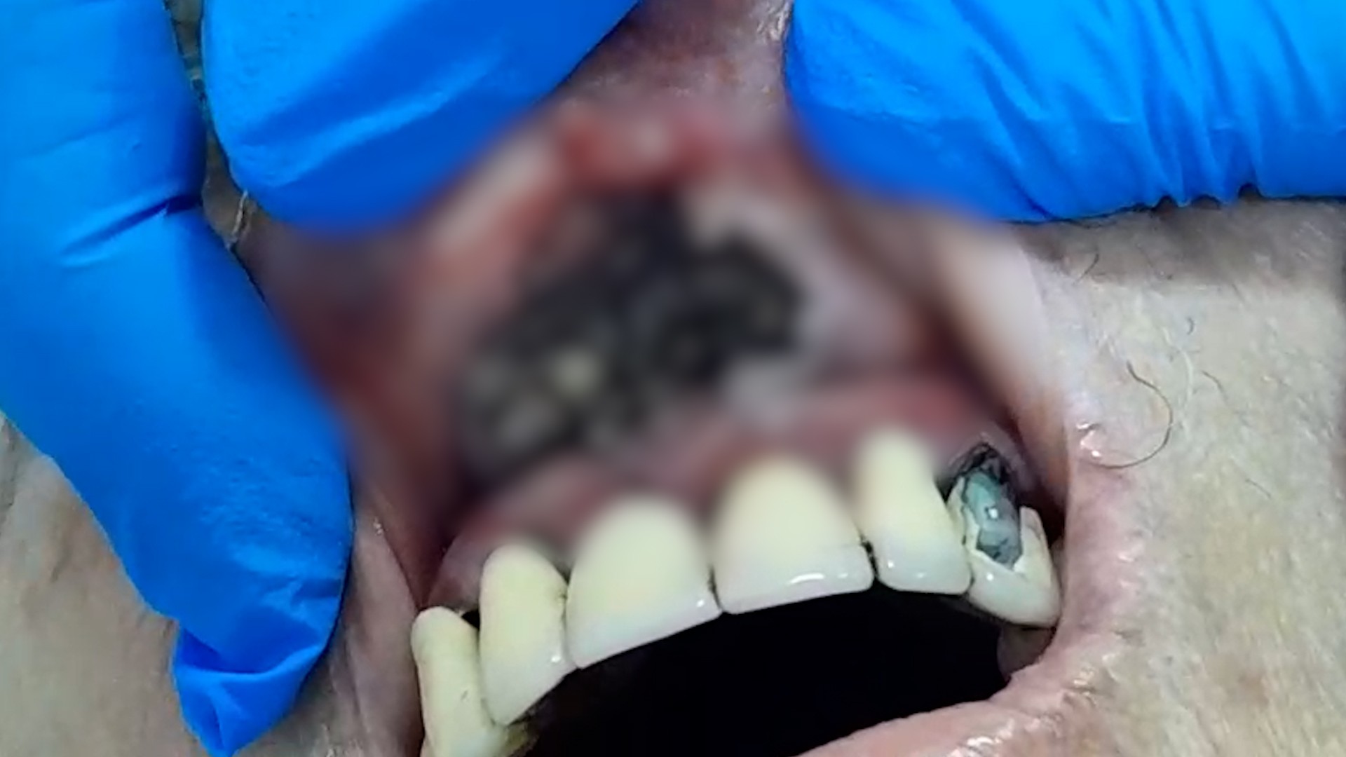 Idosa mantida em casa de repouso clandestina tem infecção grave que provoca larvas na gengiva; VÍDEO 