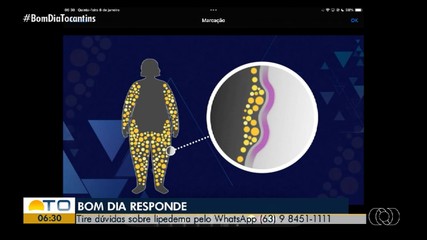 Lipedema afeta autoestima e causa distorção de imagem, diz médico