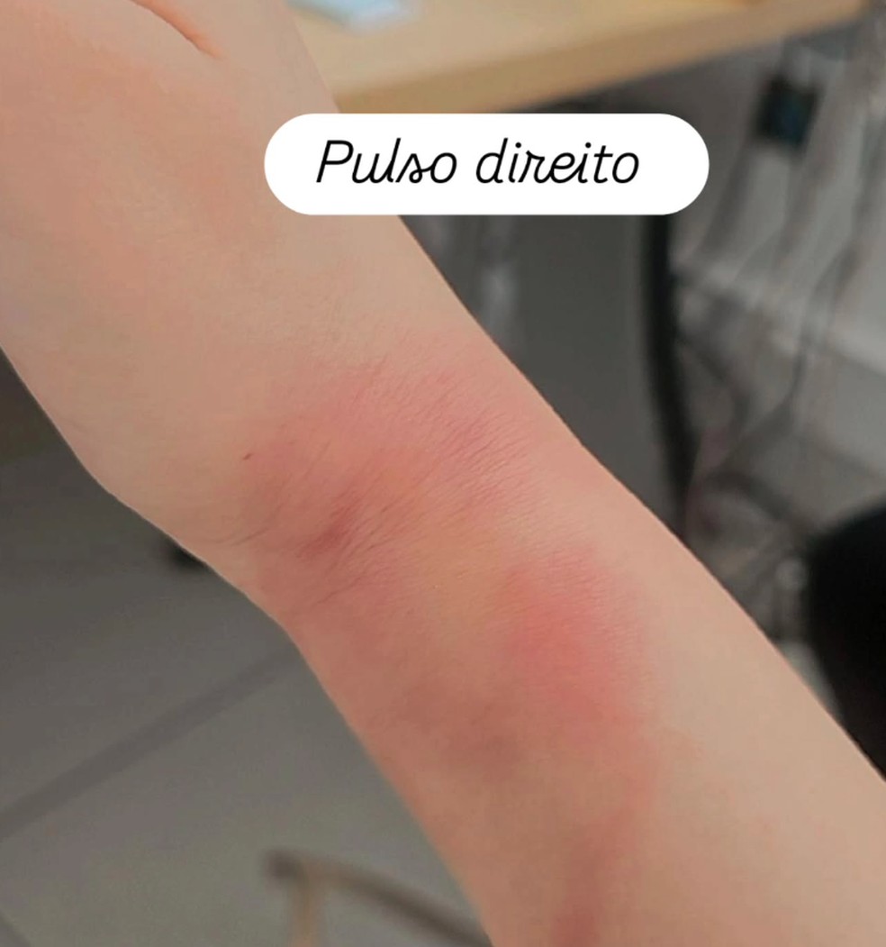 Advogada brasileira mostra hematomas no pulso direito após afirmar ter sido agredido pela polícia no aeroporto de Porto — Foto: Instagram/Reprodução