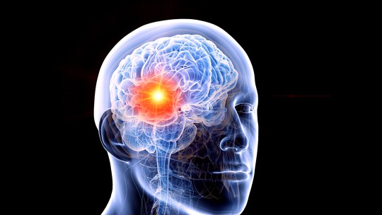 Anéis de DNA 'fora do lugar' dão pistas sobre origem e avanço de câncer cerebral agressivo -
Descoberta pode abrir caminho para diagnósticos mais precoces e novos tratamentos contra o glioblastoma, um dos tumores mais letais em adultos.
