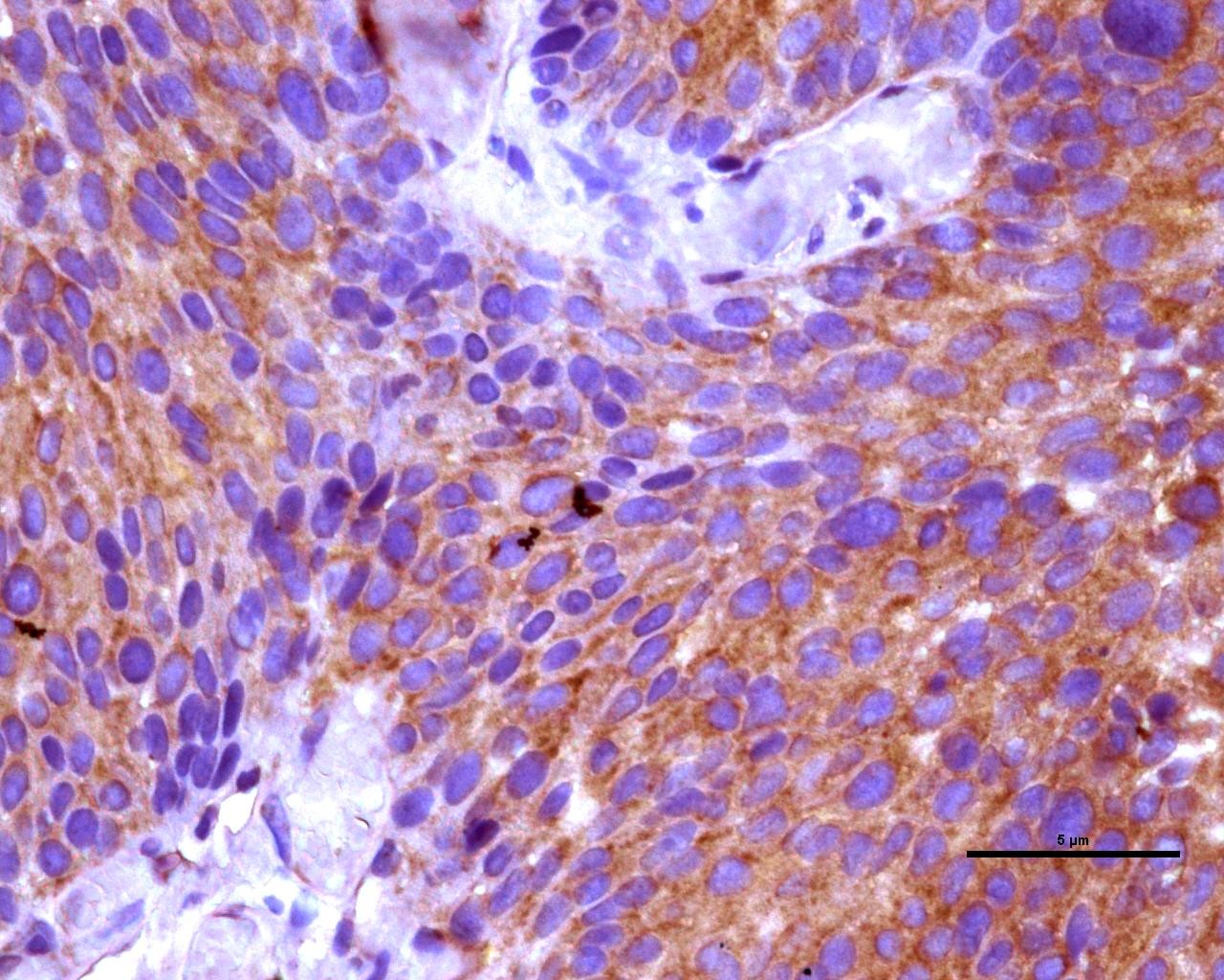 Câncer de bexiga: Unicamp descobre pistas em tumores que podem explicar por que tratamento falha em metade dos casos
