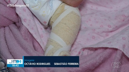 Bebê do Tocantins sofre fratura no fêmur durante teste do pezinho em Goiás