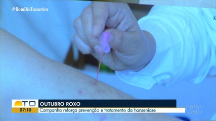 Campanha do Outubro Roxo reforça a prevenção e tratamento da hanseníase