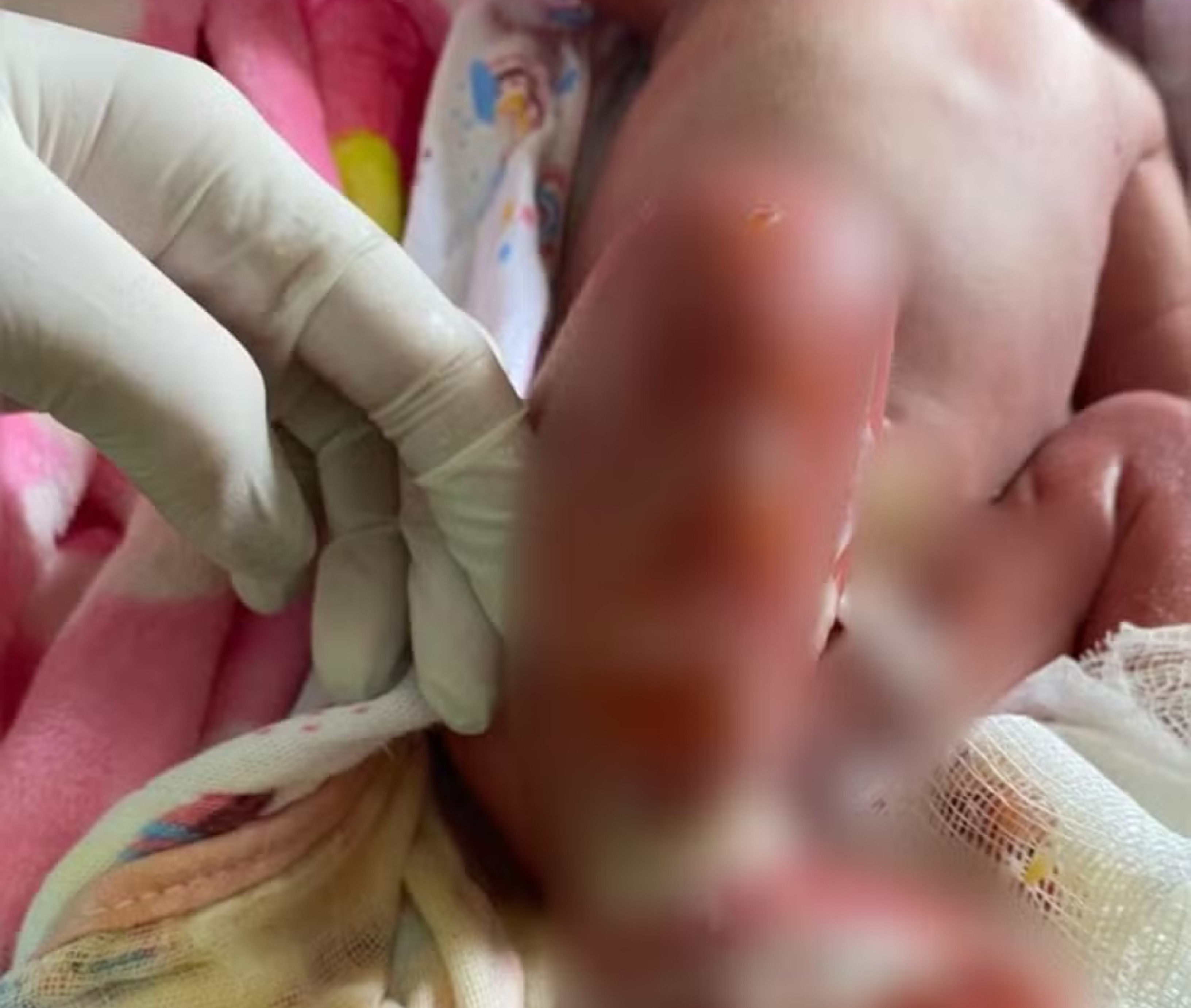Recém-nascida internada na UTI após banho em maternidade no Acre: o que se sabe e o que falta esclarecer