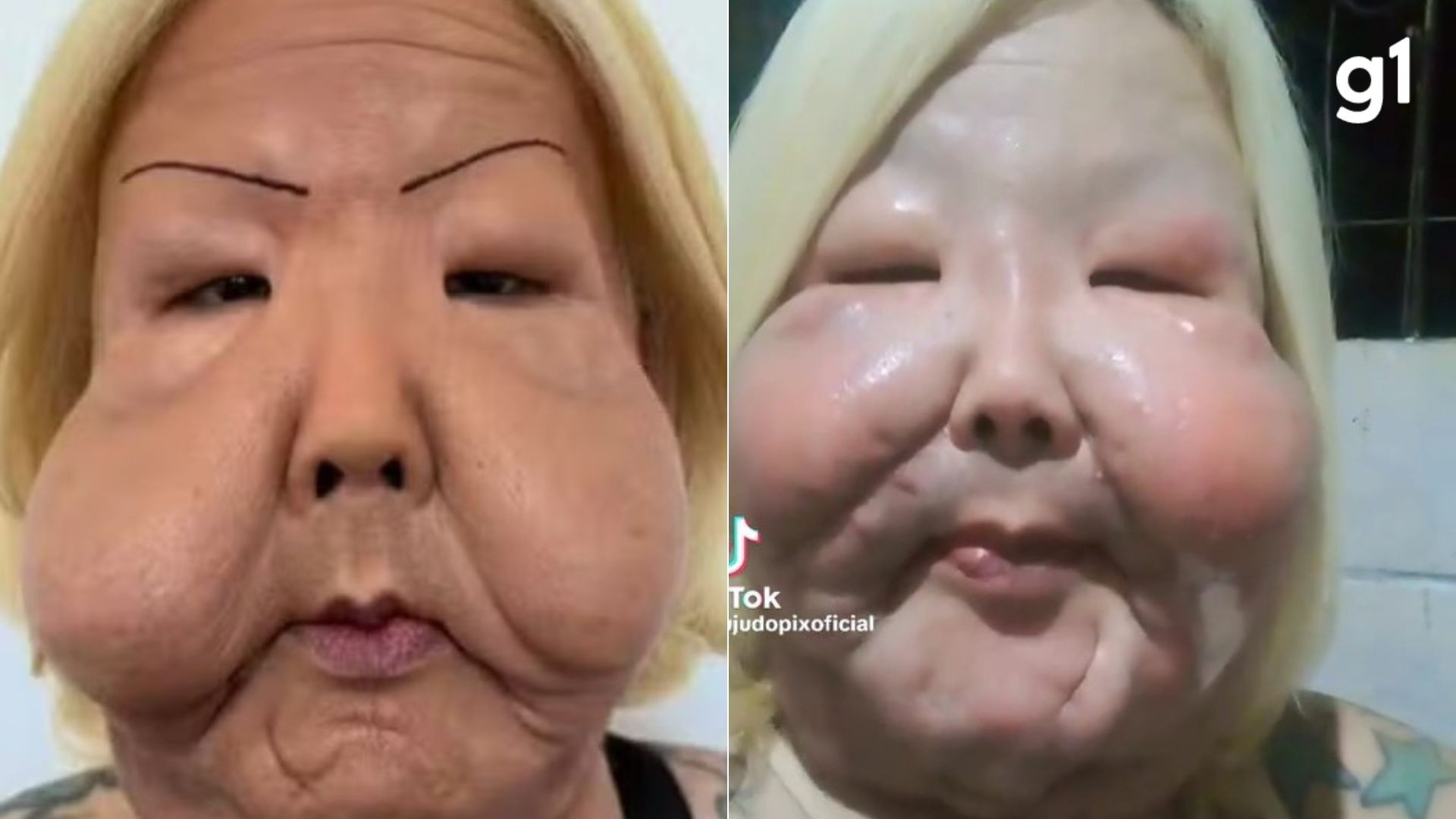 Juju do Pix relata problema em cicatrização após cirurgia para retirada de óleo mineral: 'Ponto acabou abrindo'