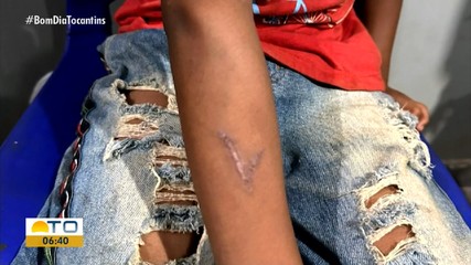Criança indígena de 6 anos é agredida com ferro de marcar gado na Ilha do Bananal
