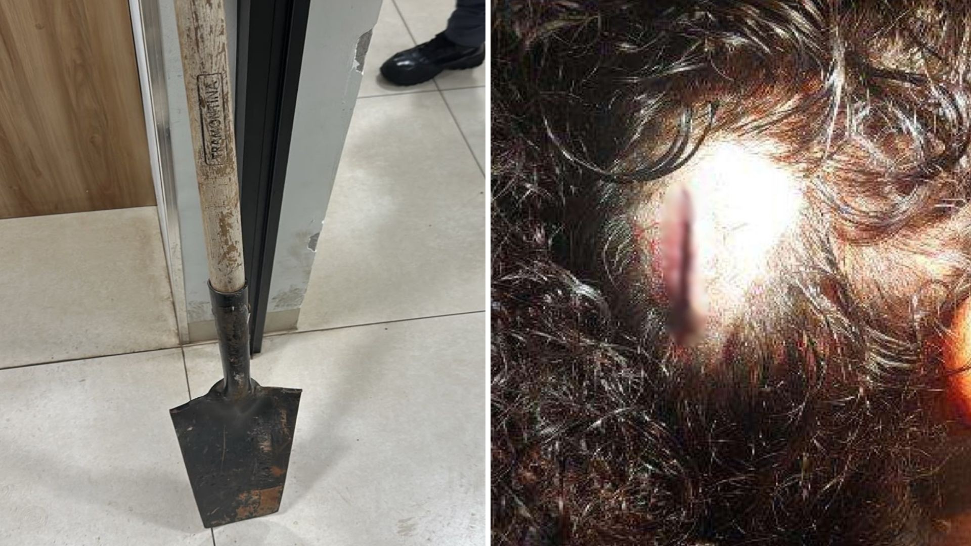 Mulher tem dedo quebrado e sofre cortes na cabeça após ser agredida com pá por homem 