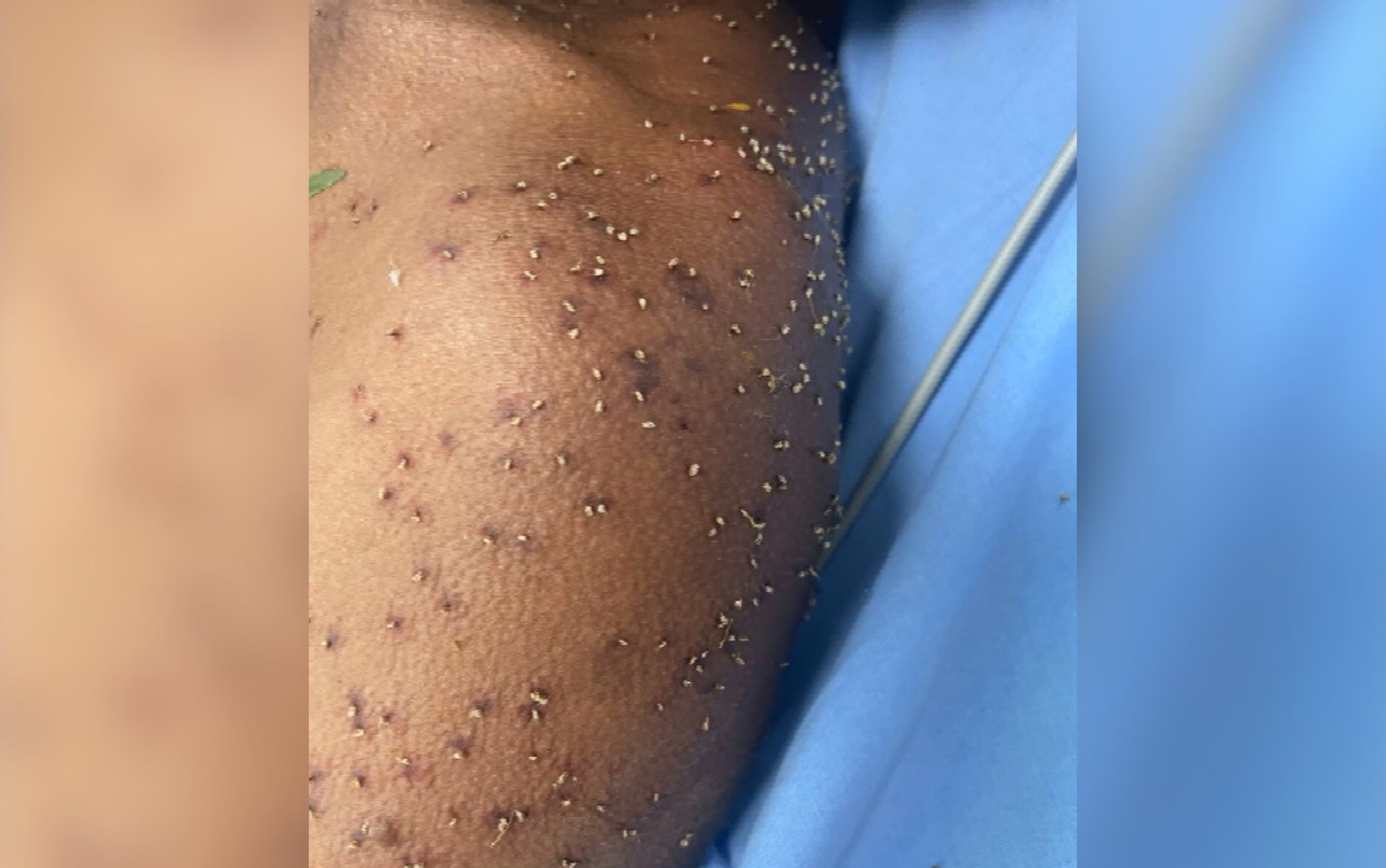 Homem leva centenas de picadas de abelha e é socorrido inconsciente pelos bombeiros, em Itapuranga