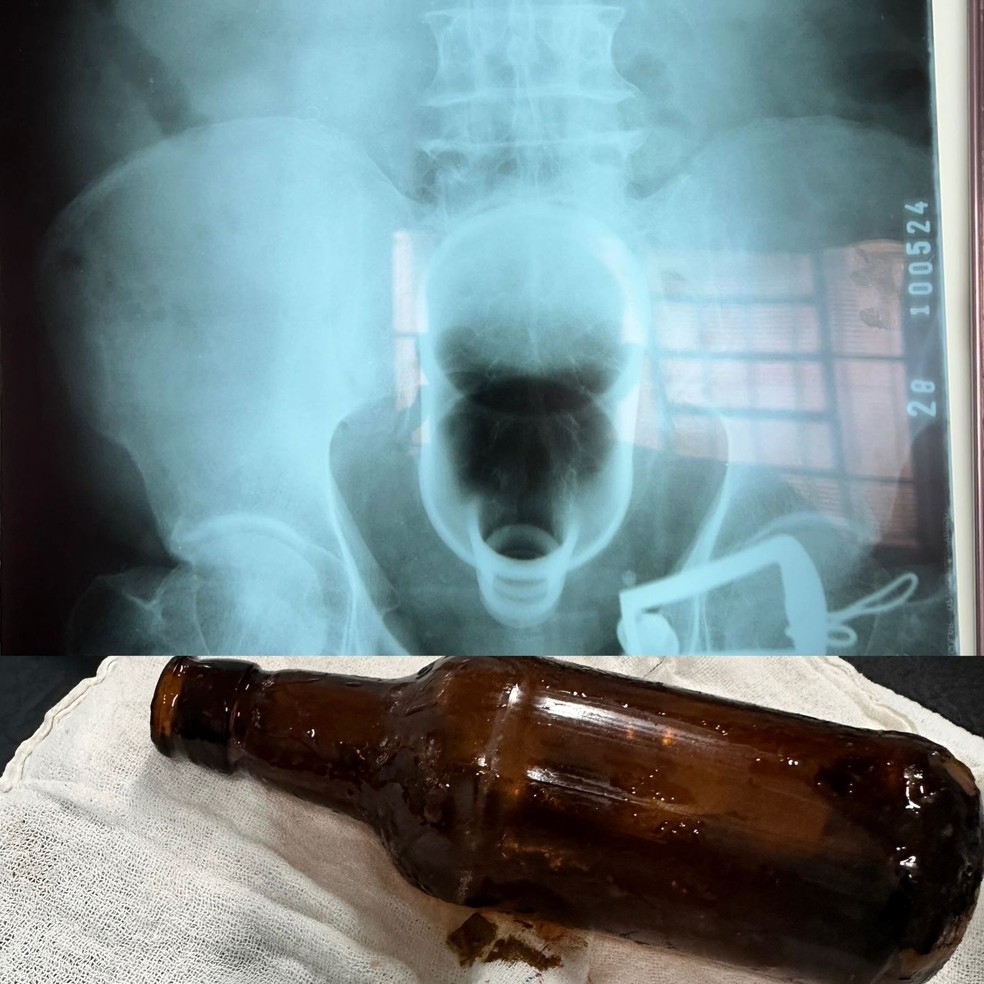 Homem introduziu garrafa no ânus, que foi parar no reto — Foto: Arquivo Pessoal