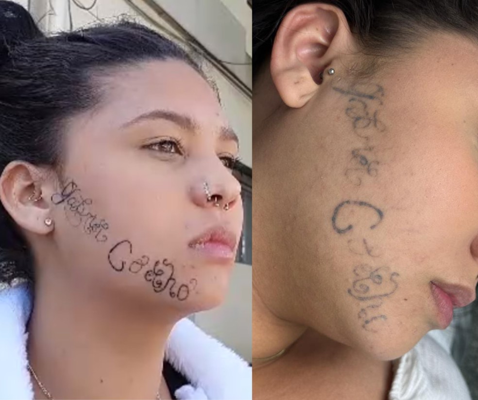 Comparação do antes e depois do rosto da Tayane, após seis sessões de laser para remoção da tatuagem. — Foto: Reprodução