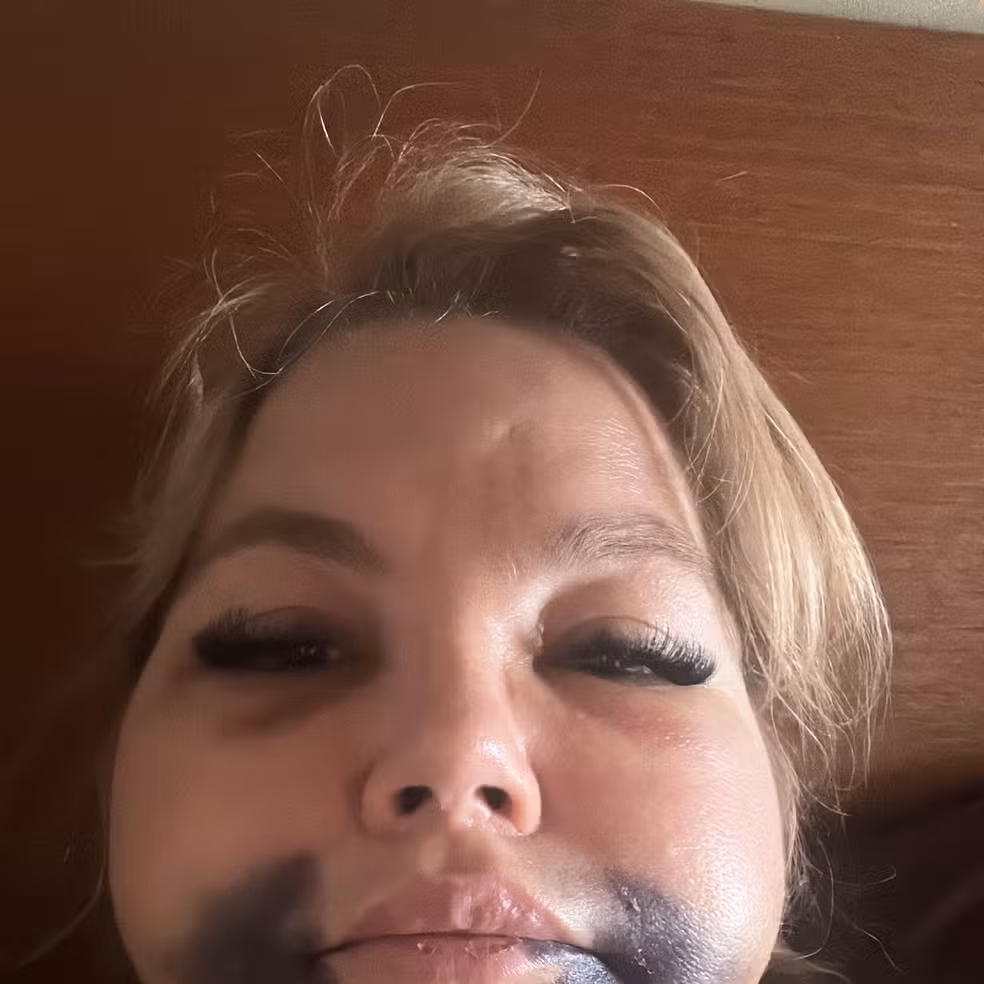 Eloah Teixeira Carneiro Lins, paciente que enfrentou problemas após procedimento estético — Foto: Reprodução/Arquivo Pessoal